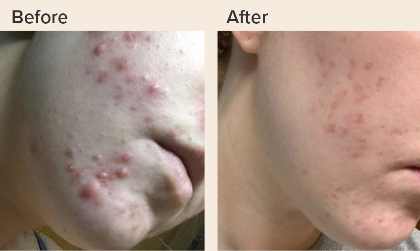 Acne-solution Acne-solution